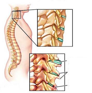 osteocondroza gulerului cervical durere surdă la nivelul coloanei vertebrale